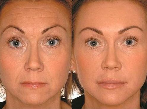 Before and after microcurrent therapy
