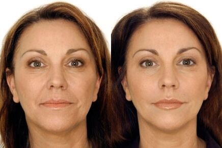 LPG massage of the face before and after