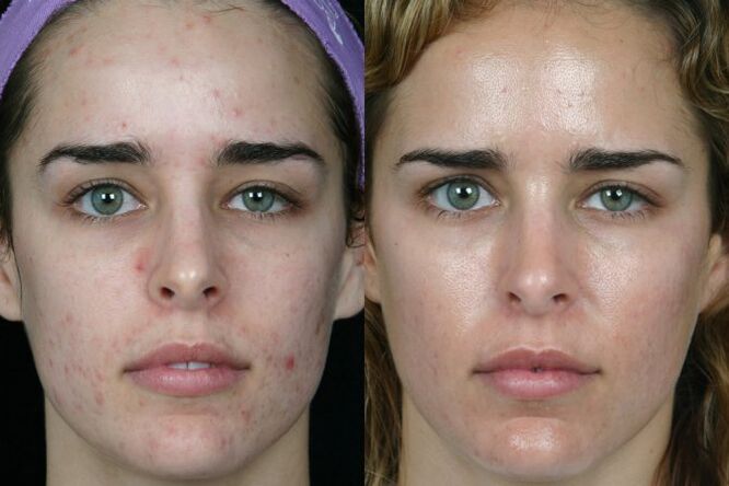 Laser grinding of the face of the face before and after